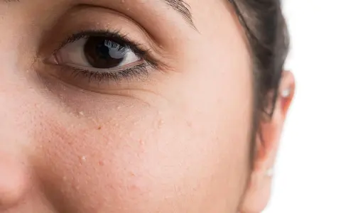Nahaufnahme eines Auges mit kleinen weißen Milien unter dem Auge, die entfernt werden sollen.