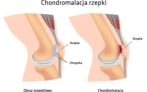 Porównanie zdrowego kolana z zaawansowaną chondromalacją 4 stopnia, gdzie chrząstka rzepki jest mocno uszkodzona.