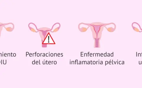 Ilustración de útero con DIU, deslizamiento, perforación, enfermedad inflamatoria pélvica e infección uterina. Reposo tras colocar el DIU Mirena.