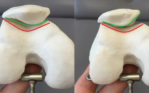 Model stawu kolanowego z zaznaczoną rzepką typu 1 wg Wiberga.