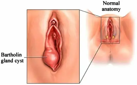 Ilustracja pokazuje torbiel gruczołu Bartholina, powiększoną w porównaniu do normalnej anatomii.