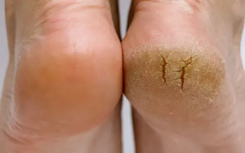 Gros plan sur deux talons, l'un sain et l'autre très sec, craquelé, montrant la différence de texture.