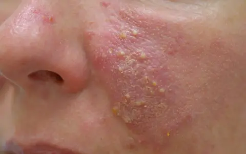 Schuppige Gesichtshaut: Ursachen, Symptome und effektive Behandlungen