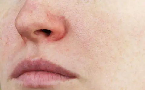 Gros plan sur un visage, avec un nez rouge froid, des lèvres fines et une peau marquée par les pores.