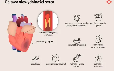 Objawy niewydolności serca: ból w klatce, omdlenia, zmęczenie, obrzęki nóg, kaszel, duszności, nudności. Zablokowana tętnica wieńcowa i uszkodzony mięsień sercowy.