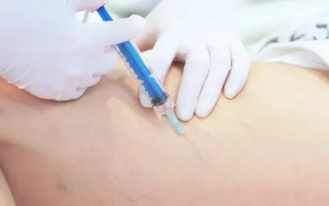 Lekarz w białej rękawiczce wykonuje zastrzyk strzykawką w nogę z widocznymi naczynkami. To skleroterapia żylaków opinie.