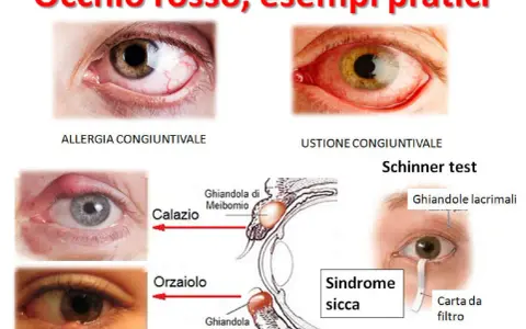 Occhio rosso che lacrima per allergia, ustione, calazio, orzaiolo e sindrome sicca. Test di Schirmer con carta da filtro.