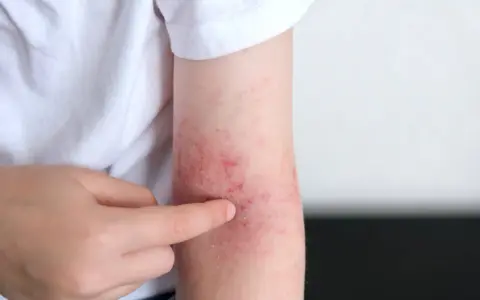 Un bras montre des rougeurs et des irritations, signe d'un possible stress peau.