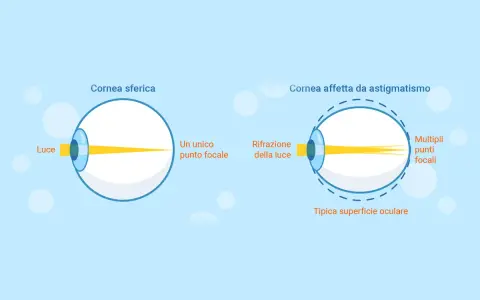 Diagramma mostra come vede un astigmatico: la luce si focalizza in più punti invece che in uno solo, creando una visione sfocata.