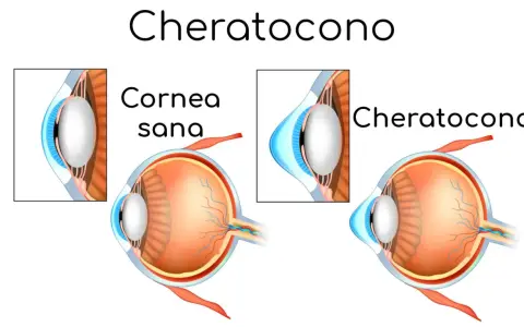 Confronto tra cornea sana e cheratocono: la vista di un occhio sano e uno affetto da cheratocono, che mostra la deformazione della cornea.