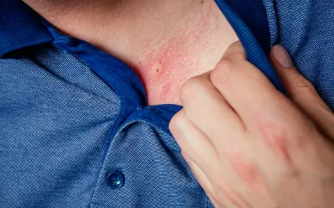 Pelle arrossata e irritata sul collo, possibile dermatite da stress. Una mano solleva il colletto di una camicia blu.