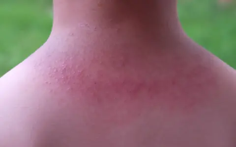 Sarpullido en el cuello, con piel enrojecida y pequeños bultos.