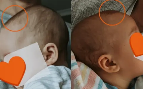 Porównanie główki niemowlaka: po lewej widoczne zapadnięte ciemiączko, po prawej stan poprawiony.