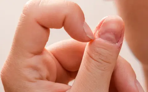 Dłoń z widocznym nawykiem obgryzania paznokci, skórki wokół paznokcia są zaczerwienione i podrażnione.