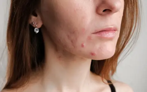 Skóra kobiety po 30. z widocznym trądzikiem hormonalnym na policzku i brodzie. Widoczne zaczerwienienia i wypryski.