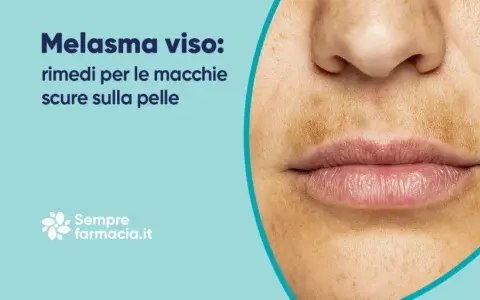 Primo piano del viso con macchie scure sopra il labbro, tipiche del melasma baffetti. Rimedi per le macchie scure sulla pelle.