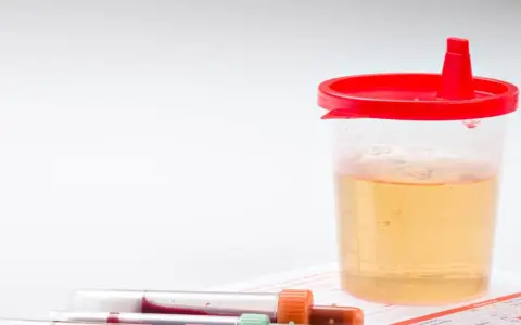 Pojemnik z żółtym płynem i próbówki z krwią. Wyniki badań wskazują na erytrocyty w moczu.