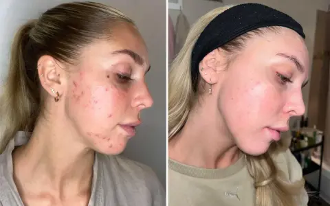 Före- och efterbilder visar en kvinnas hud med hormonspiral akne som förbättrats avsevärt.
