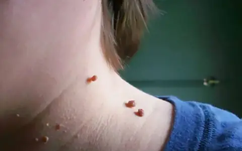 Piel con varias verrugas marrones y rojizas en el cuello, algunas agrupadas, sugiriendo la necesidad de quemar verrugas.