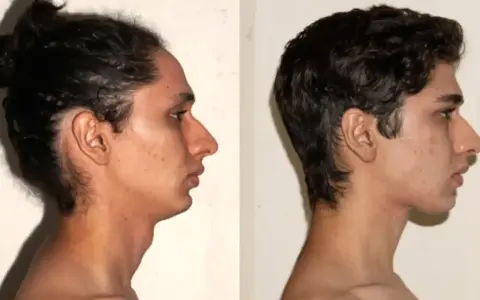 Comparación de perfiles faciales. El lado izquierdo muestra una mandíbula retraída, mientras que el derecho, tras practicar que es mewing, revela un perfil más definido.