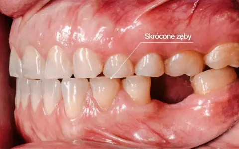 Widoczne skrócone zęby, jeden z objawów bruksizmu. Zęby są starte, co może prowadzić do bólu i dyskomfortu.