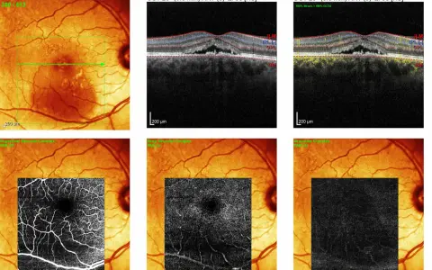 Immagini OCT e IR di un occhio con segni di retinopatia da stress, mostrando alterazioni vascolari e strutturali.
