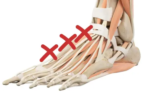 Anatomia del piede con tre croci rosse sui tendini, indicando un problema come il collo del piede gonfio.
