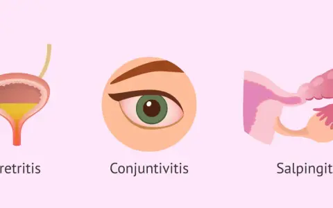 Ilustración muestra uretritis, conjuntivitis y salpingitis, afecciones que puede causar la clamidia.