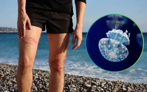 Gamba con segni rossi, forse da medusa. Immagine di una medusa blu e bianca. Cosa fare se ti tocca una medusa.