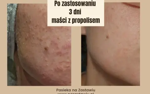 Przed i po 3 dniach stosowania maści z propolisem. Skóra z niedoskonałościami staje się gładsza.