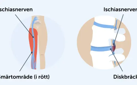 Illustration av ischiasnerven och smärtområde i benet, samt diskbråck som orsakar falsk ischias.