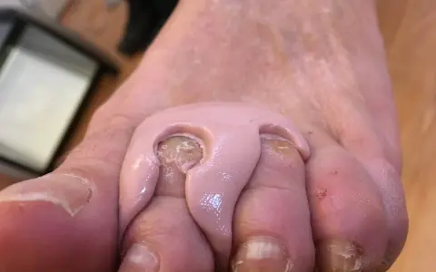 Orthoplastie podologue : un pansement rose est appliqué entre les orteils pour soulager une douleur.