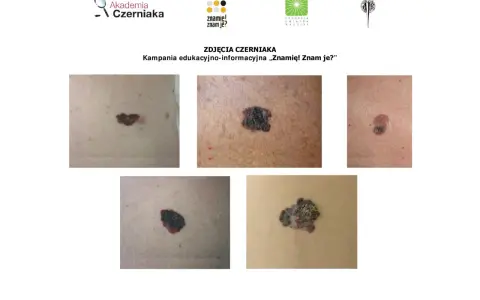 Zbliżenia różnych znamion i czerniaków na skórze.