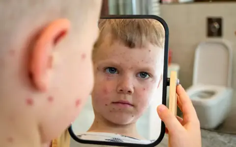Chłopiec z ospą wietrzną patrzy w lustro. Szuka informacji: co na ospę bez recepty, by ulżyć w swędzeniu.