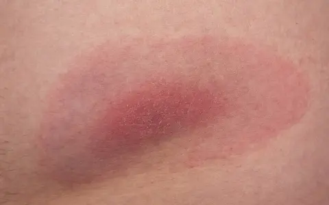 Rumień wędrujący, objaw kleszcza pod skórą, rozszerza się. Czerwona plama na skórze.