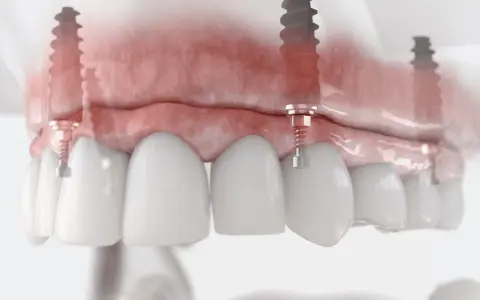 Model szczęki z implantami. Podniesienie dna zatoki szczękowej cena zabiegu jest kluczowa dla stabilności implantów.