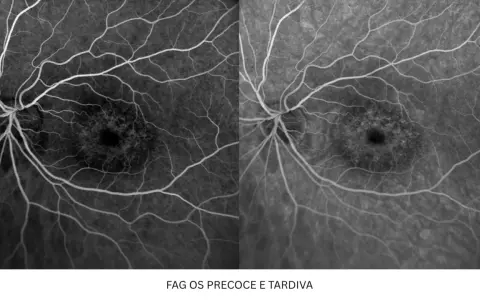 Immagini retiniche con fluoresceina. Possibili effetti collaterali da considerare, ma qui si osservano i vasi sanguigni.