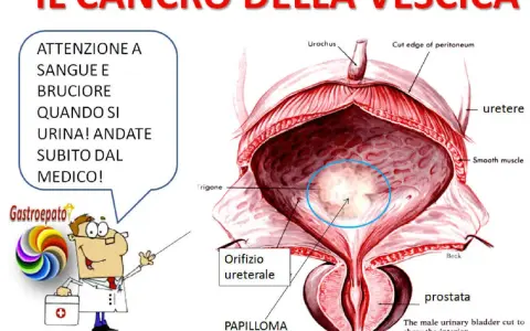 Illustrazione anatomica della vescica maschile con un'area evidenziata che indica un tumore alla vescica. Avviso: sangue e bruciore durante la minzione richiedono visita medica immediata.