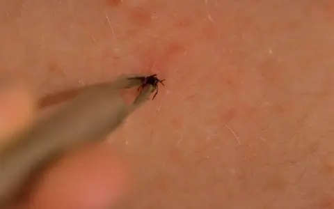 Jak bezpiecznie usunąć kleszcza? Sprawdź instrukcję krok po kroku