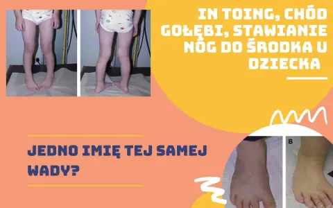 Dziecko z zaburzeniami chodu: "chod gołębi", "stawianie nóg do środka". Czy to ta sama wada?