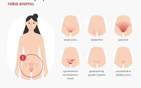 Ilustracja pokazuje wczesne objawy raka sromu: świąd, pieczenie, dyskomfort, zgrubienia, grudki i owrzodzenia.