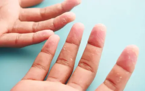 Mains affectées par la dyshidrose, avec des vésicules et une peau qui pèle sur les doigts.