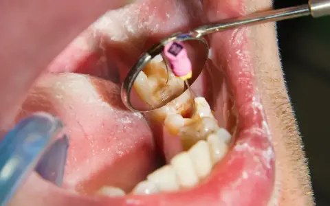 Zgorzel zęba to martwica miazgi. Widoczny ząb w lustrze dentystycznym, z narzędziem w kanale korzeniowym.