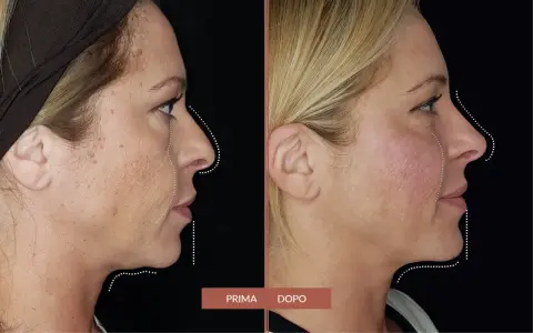 Prima e dopo: il filler full face ha ridefinito i contorni del viso, migliorando la pienezza e la definizione.