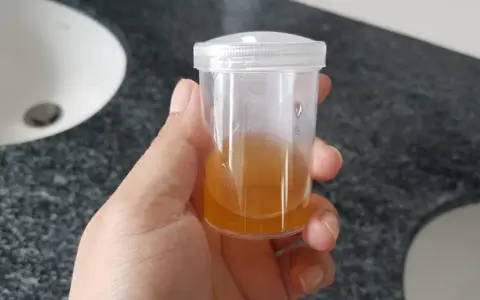 Próbka moczu z widocznymi fosforanami bezpostaciowymi, ważna w diagnostyce ciąży.