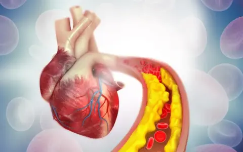 Serce i tętnica z miażdżycą. Żółte złogi cholesterol nie-hdl zwężają naczynie, utrudniając przepływ krwi.