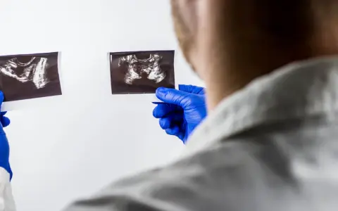 Lekarz w niebieskich rękawiczkach analizuje dwa zdjęcia USG, szukając odpowiedzi na pytanie: rak prostaty ile się żyje.