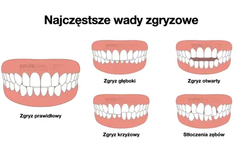 Ilustracja pokazuje różne wady zgryzu: prawidłowy, głęboki, otwarty, krzyżowy i stłoczenia zębów.