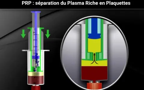 Illustration d'une seringue pour la séparation du plasma riche en plaquettes (PRP) pour un cheval.