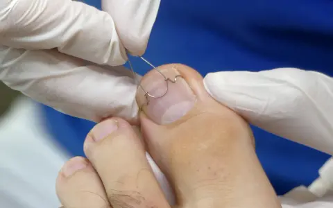 Application d'une orthonyxie sur un ongle incarné. Des mains gantées ajustent un fil métallique pour corriger la courbure de l'ongle.